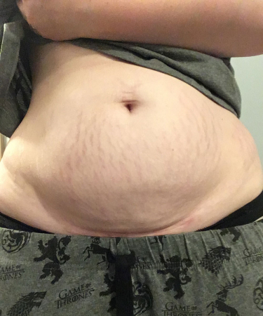 10 Vrouwen Laten Hun Buik Na De Zwangerschap Zien