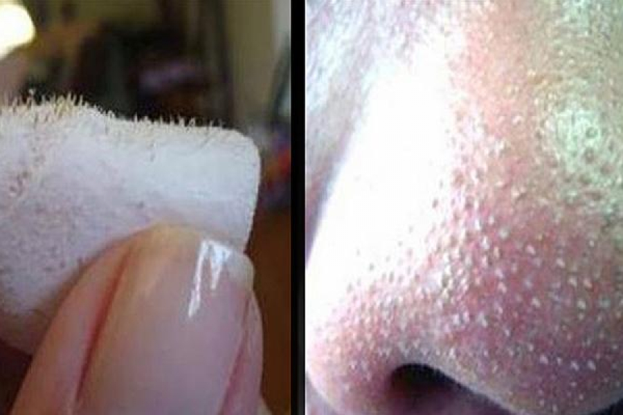 Zwarte Puntjes Met Dit Trucje Verwijder Je Ze Makkelijk Allemaal