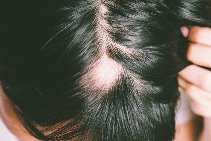 Alopecie Androgenetique Comment La Reconnaitre Et Quelles Sont Les Solutions