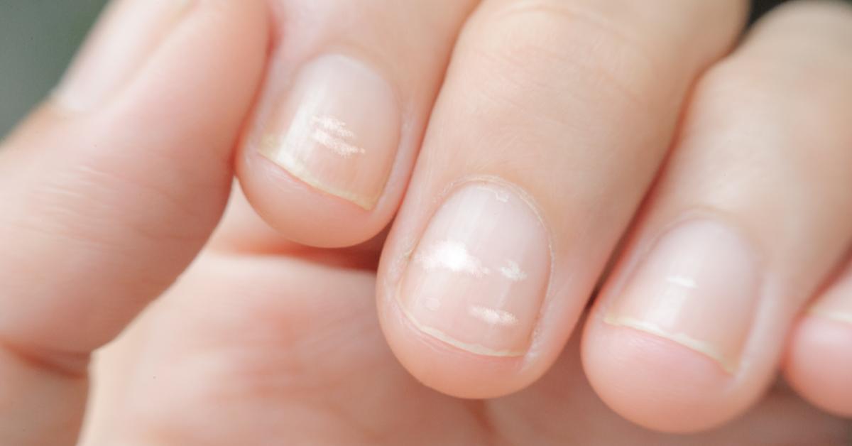 Verzorger Garantie Mellow AHA: dit betekenen die witte vlekken op je nagels (en zo kom je er vanaf)