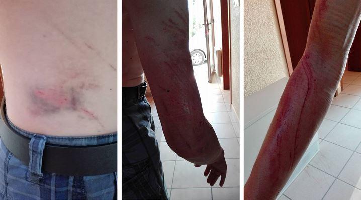 Niet voor doetjes: mountainbiker uit Izegem toont blessures na val in prikkeldraad