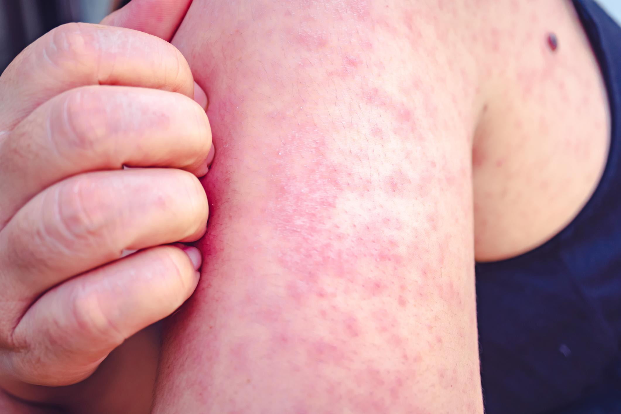 Zonneallergie en andere reacties op de zon dit moet je weten Libelle