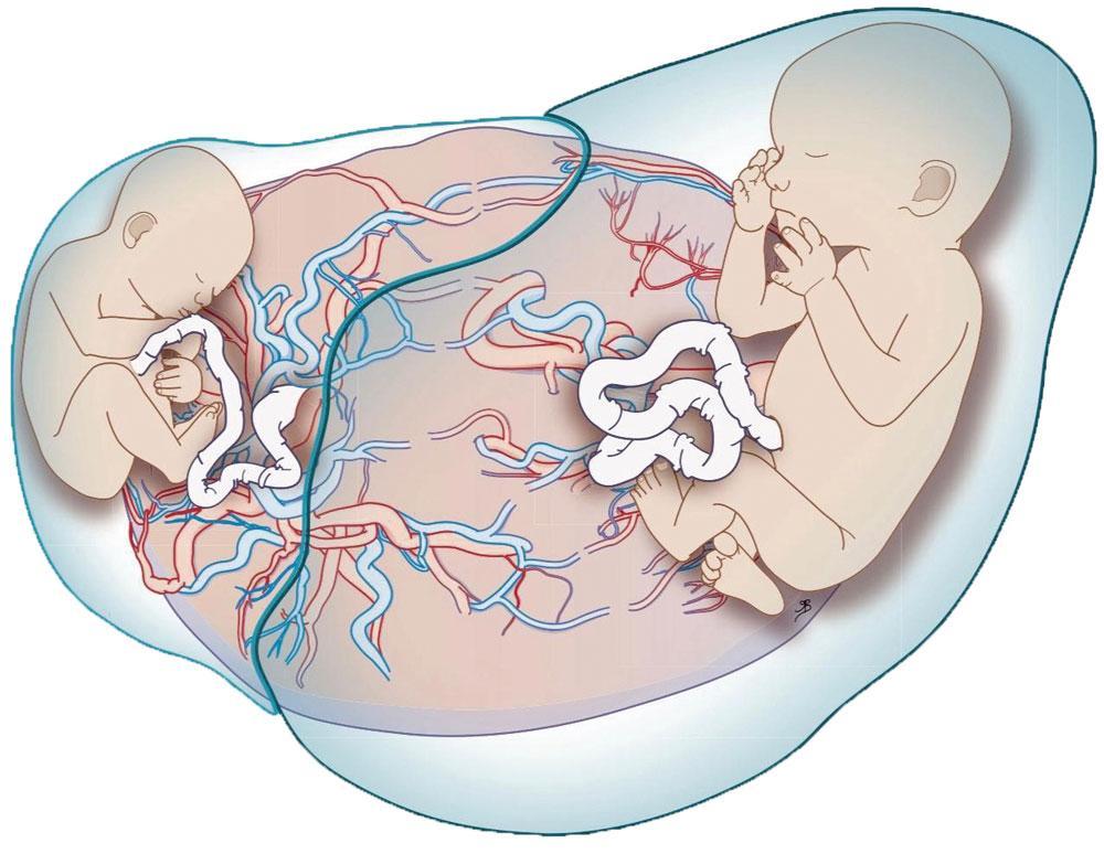In vergelijking met eenlingen groeien tweelingen minder snel vanaf 32 zwangerschapsweken. Vaak blijft 1 foetus wel mooi verder groeien, terwijl de andere achterblijft. Dat risico is het grootst als er maar 1 moederkoek is.