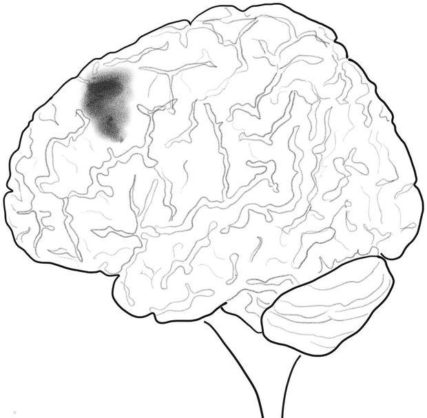 Pornobrein: beeld van het rechterstriatum in de linker dorso-laterale prefrontale cortex. De functionaliteit van dit deel van het brein hangt samen met de hoeveelheid porno die men per week ziet.