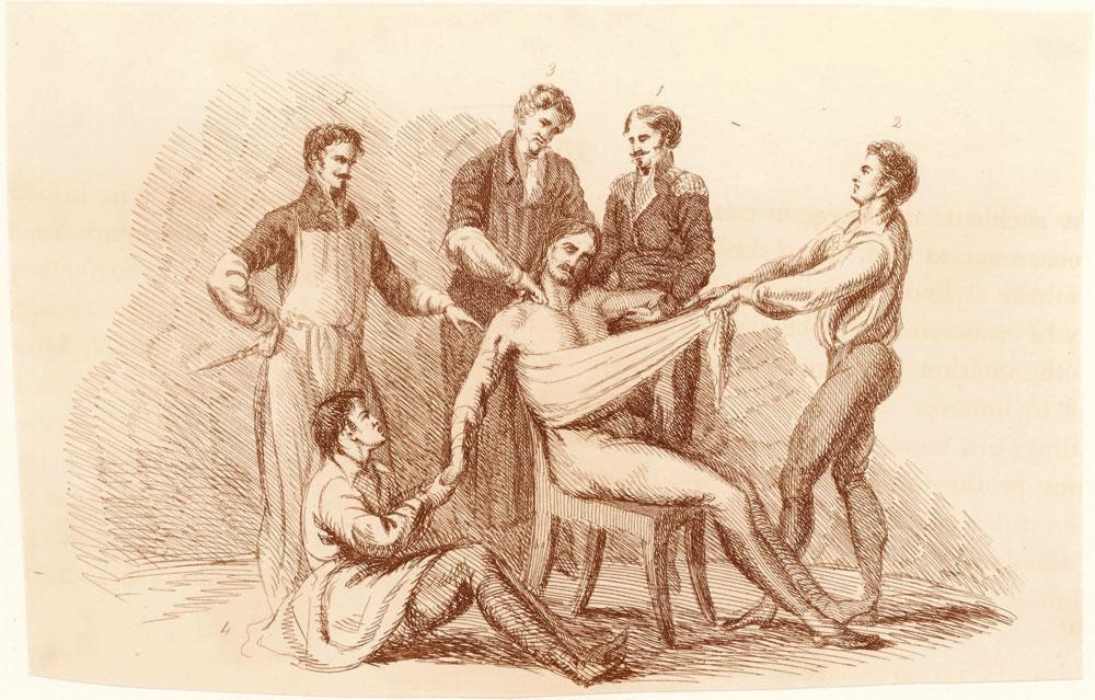 Voor de introductie van de anesthesie. Illustratie uit het boek Illustrations of the Great Operations of Surgery (1821) van Charles Bell, die in Waterloo als chirurgijn aan de slag was.