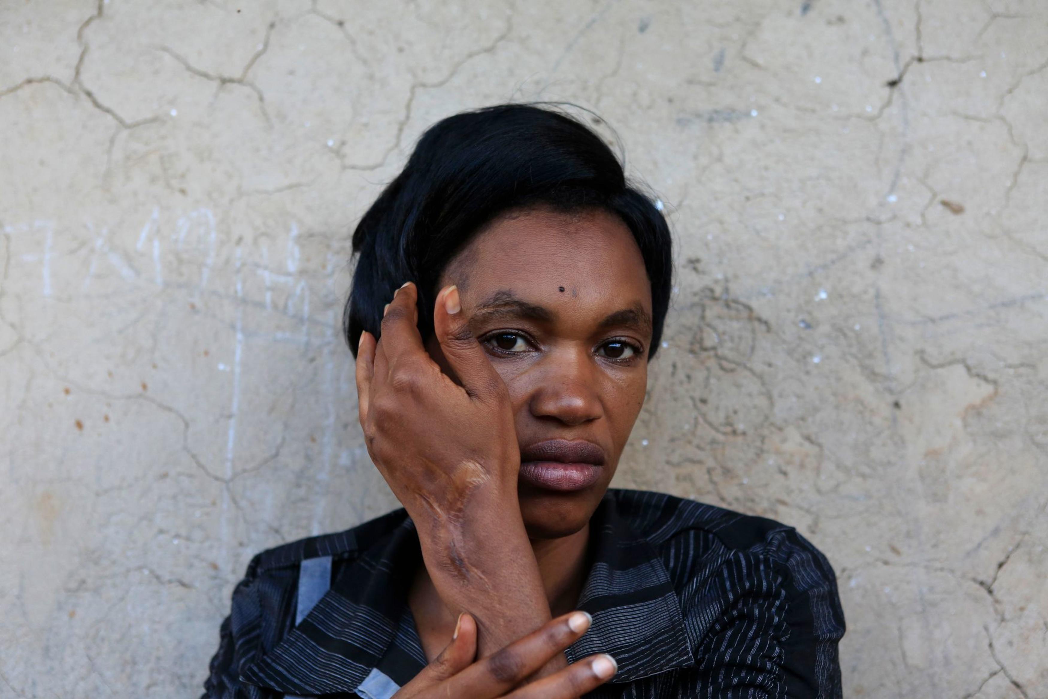 Ernestine Mudahogora (34) is een van de overlevende slachtoffers van de genocide, Kigali, 3 april 2014.