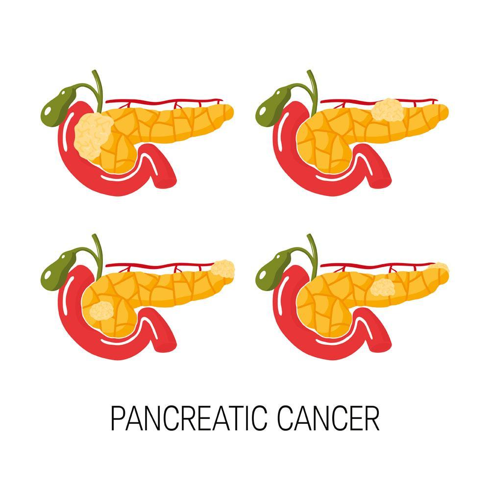 Dodelijker dan borstkanker: de stille opmars van pancreaskanker
