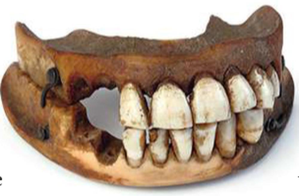 Een kunstgebit met zogeheten Waterlootanden. De tanden van deze prothese zijn afkomstig van een gesneuvelde militair uit de Amerikaanse Burgeroorlog (1850-1856). (Coll. Victoria Gallery and Museum, Liverpool)