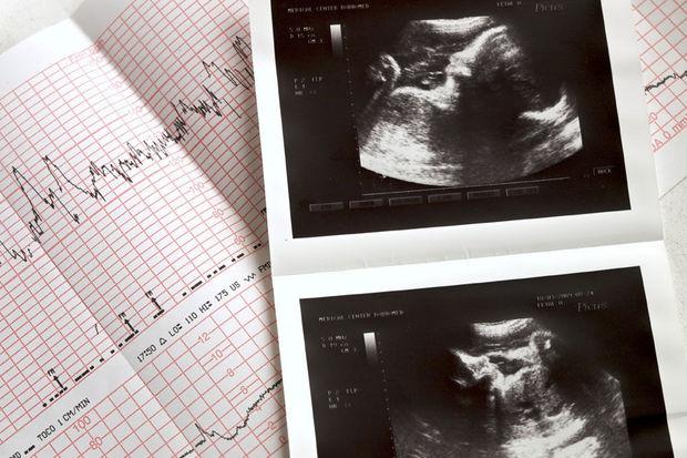 Abortus bij Downkinderen: 'Vergelijk ons niet met moordenaars'