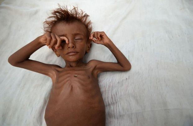 Door blokkades door Saudi-Arabië dreigt een hongersnood in Jemen. Intensievezorgafdelingen liggen er vol met ondervoede kinderen. 