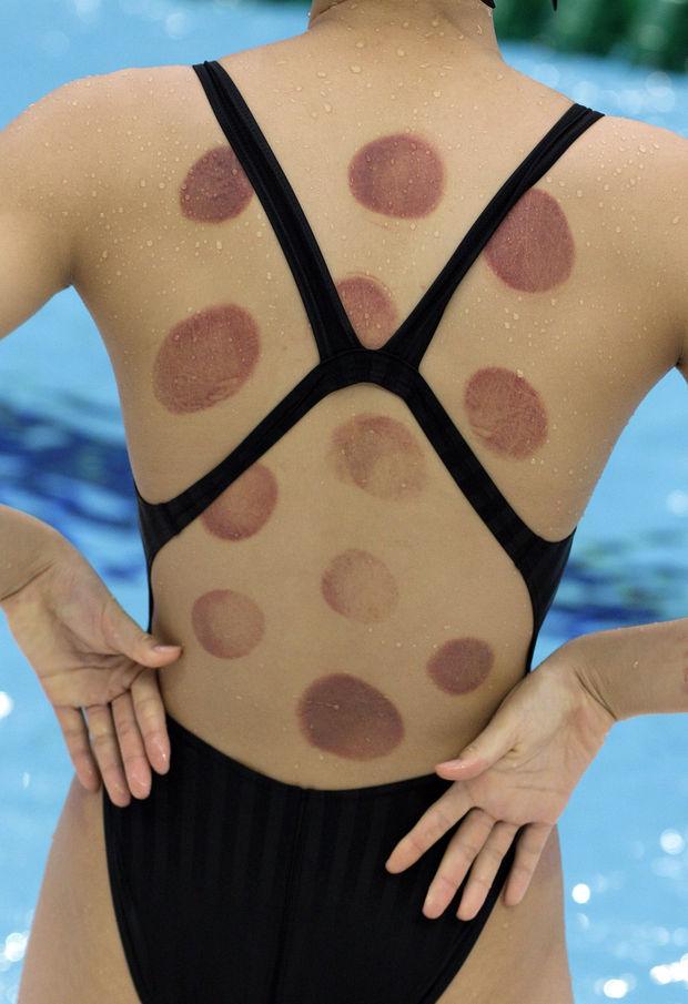 Waarom hebben zoveel olympische atleten ronde rode plekken op hun lichaam?