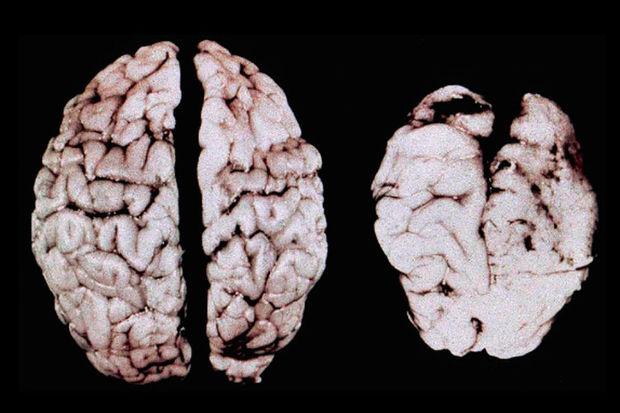 Op MRI-scans zie je een duidelijk verschil tussen een gezond brein en aangetaste hersenen.