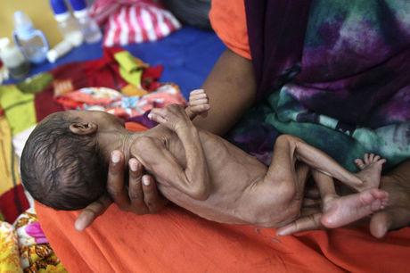 Een Somalische vrouw met haar ondervoed kind