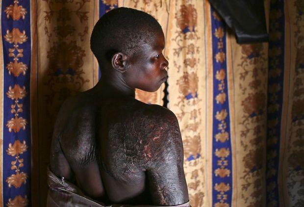 Een vrouw toont aan een onderzoeksteam van het Hof in Den Haag de littekens die ze overhield aan een aanval van de troepen van Kony