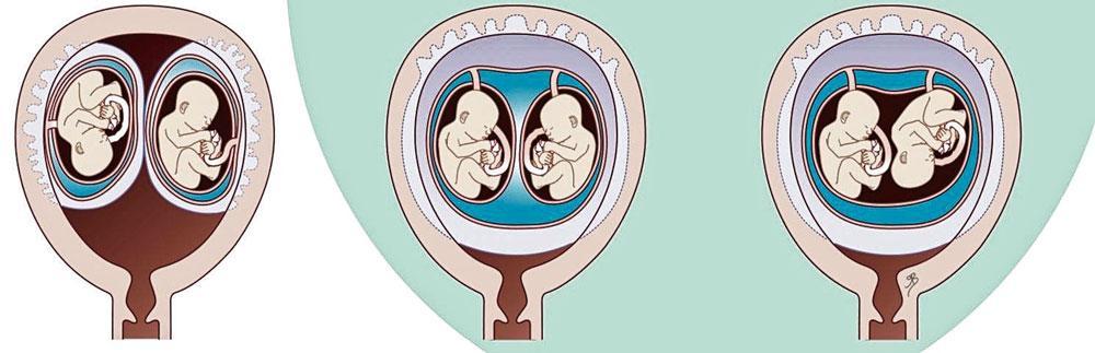 La plupart des vrais jumeaux  partagent un même placenta (voire, très rarement,  une même poche amniotique)