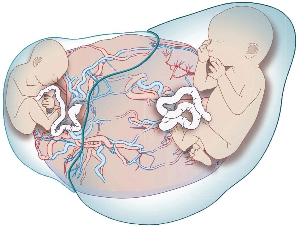 En comparaison avec un foetus unique, les jumeaux tendent à grandir moins vite à partir de 32 semaines de grossesse. Il est aussi fréquent que l'un des deux continue à grandir normalement tandis que l'autre reste à la traîne, en particulier lorsqu'il n'y a qu'un seul placenta.