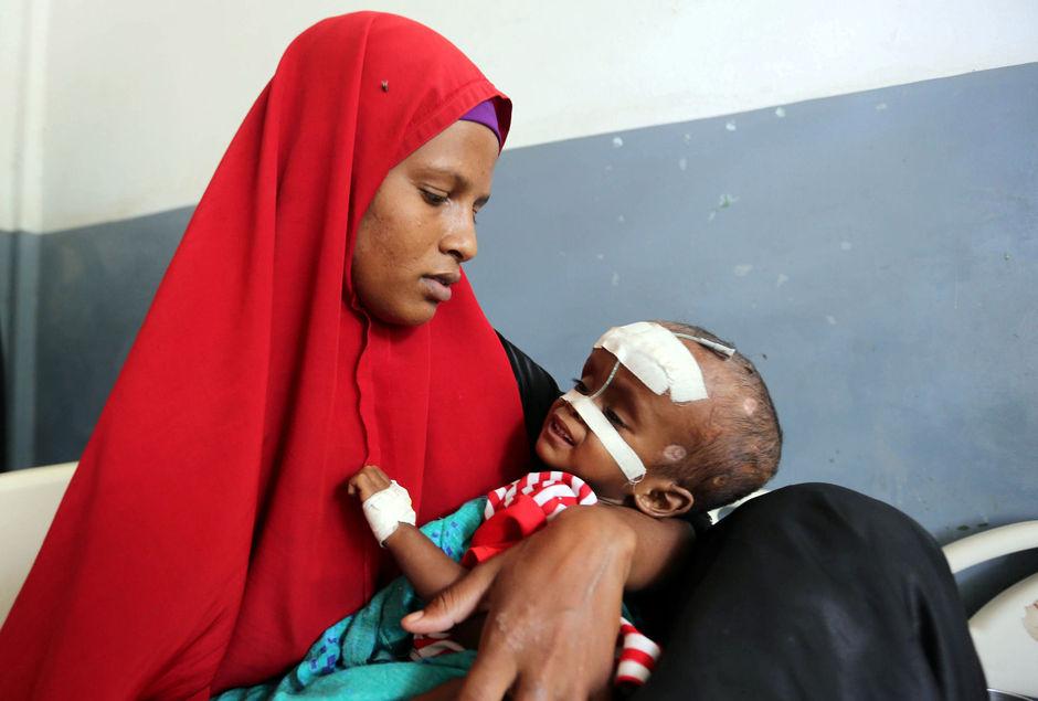 Un enfant souffrant de malnutrition est soigné à l'hôpital de Mogasdiscio en Somalie. 