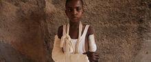 Mamoudou, 12 ans, a été attaqué à la machette par des combattants anti-balaka et laissé pour mort. Il a perdu son bras gauche. 
