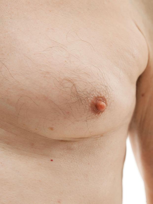 Mannen met borsten: 'Borstverkleiningen zijn geen zeldzame ingrepen meer'