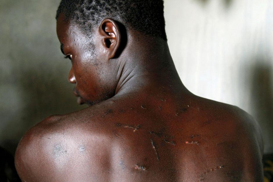 Zongo Meda toont zijn wonden nadat hij geslagen is op een cacaoplantage. 