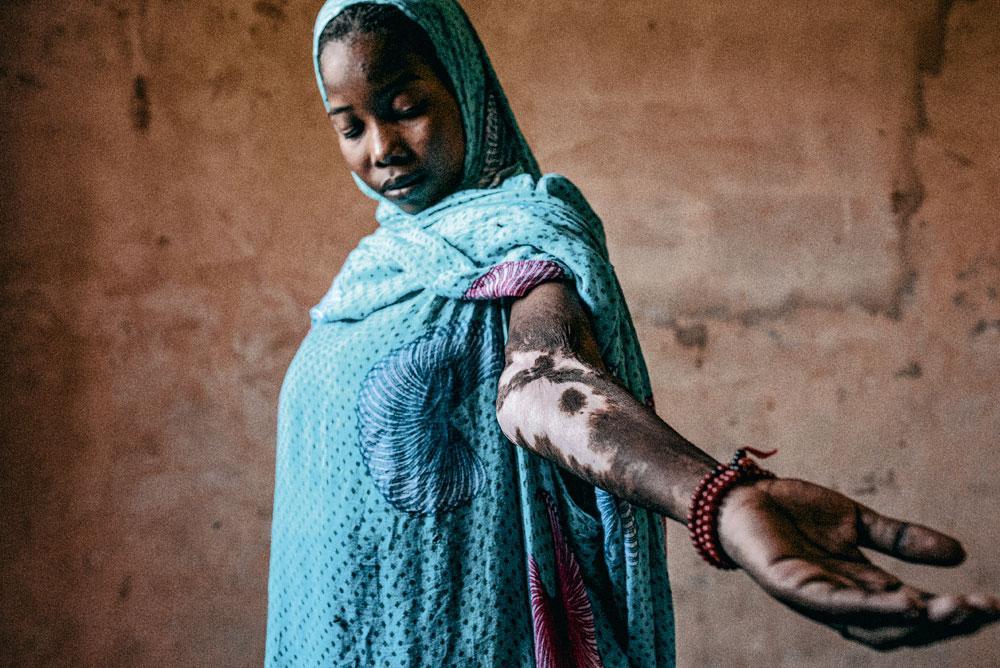 Mabrouka, 20 ans, s'est brûlée gravement au bras gauche alors qu'elle cuisinait pour ses maîtres. Mal soignée, elle souffre toujours de douleurs. Libérée en 2011 à l'âge de 14 ans, Mabrouka  n'a jamais pu aller à l'école. Elle  s'est mariée à l'âge de 16 ans.