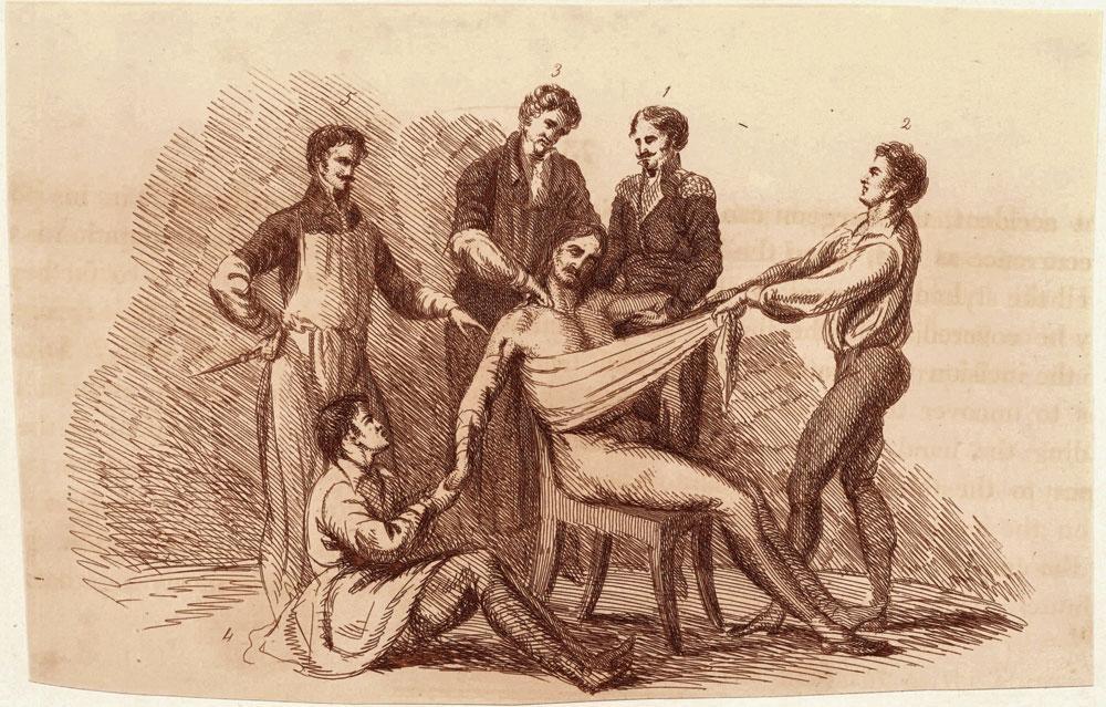 Introduction à l'anesthésie, extrait de Illustrations of the Great Operations of Surgery (1821), par Charles Bell, chirurgien qui a notamment opéré à Waterloo.