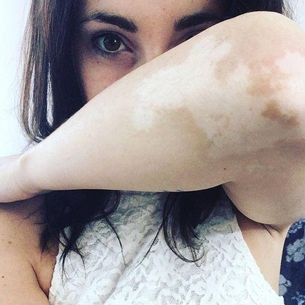 Sarah Celeapcä est atteinte de vitiligo depuis l'âge de huit ans