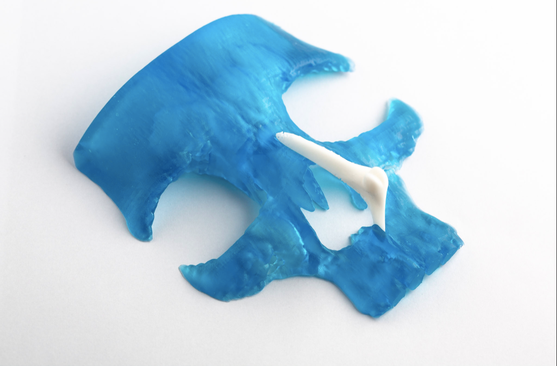 Arête nasale artificielle imprimée en 3D.