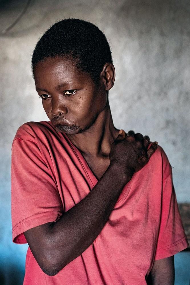 Marie Mbitile Adesa, 20 ans. A passé sept ans en brousse. Mutilée par la LRA.