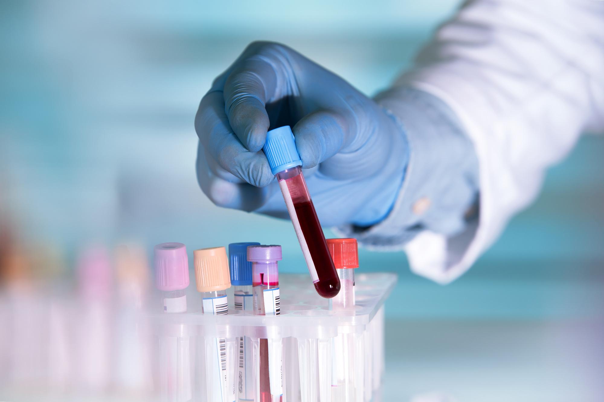 Transfusion de plasma de patients guéris du coronavirus: des résultats encourageants en Belgique