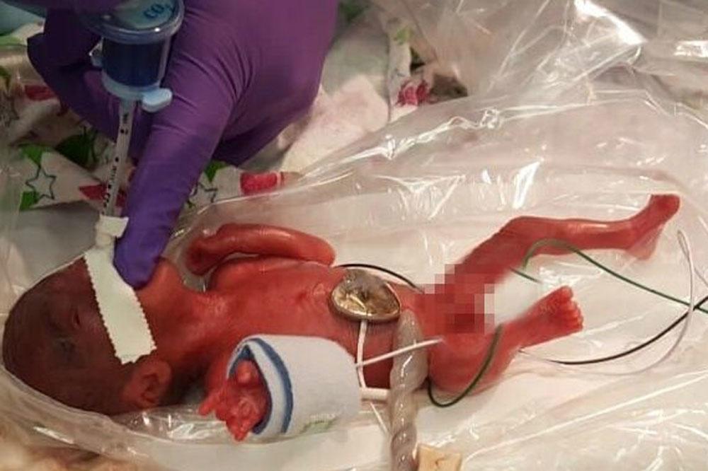 Avec ses 245 grammes, Saybie est le plus petit bébé du monde à être venu au monde en vie