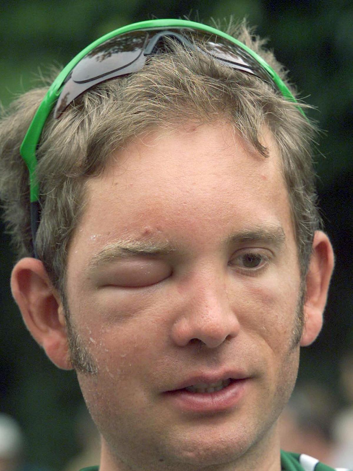 In 2001 moest renner Jonathan Vaughters, de Amerikaan van Crédit Agricole, na 10 kilometer opgeven omdat zijn linkeroog compleet dichtzat door een wespensteek. 