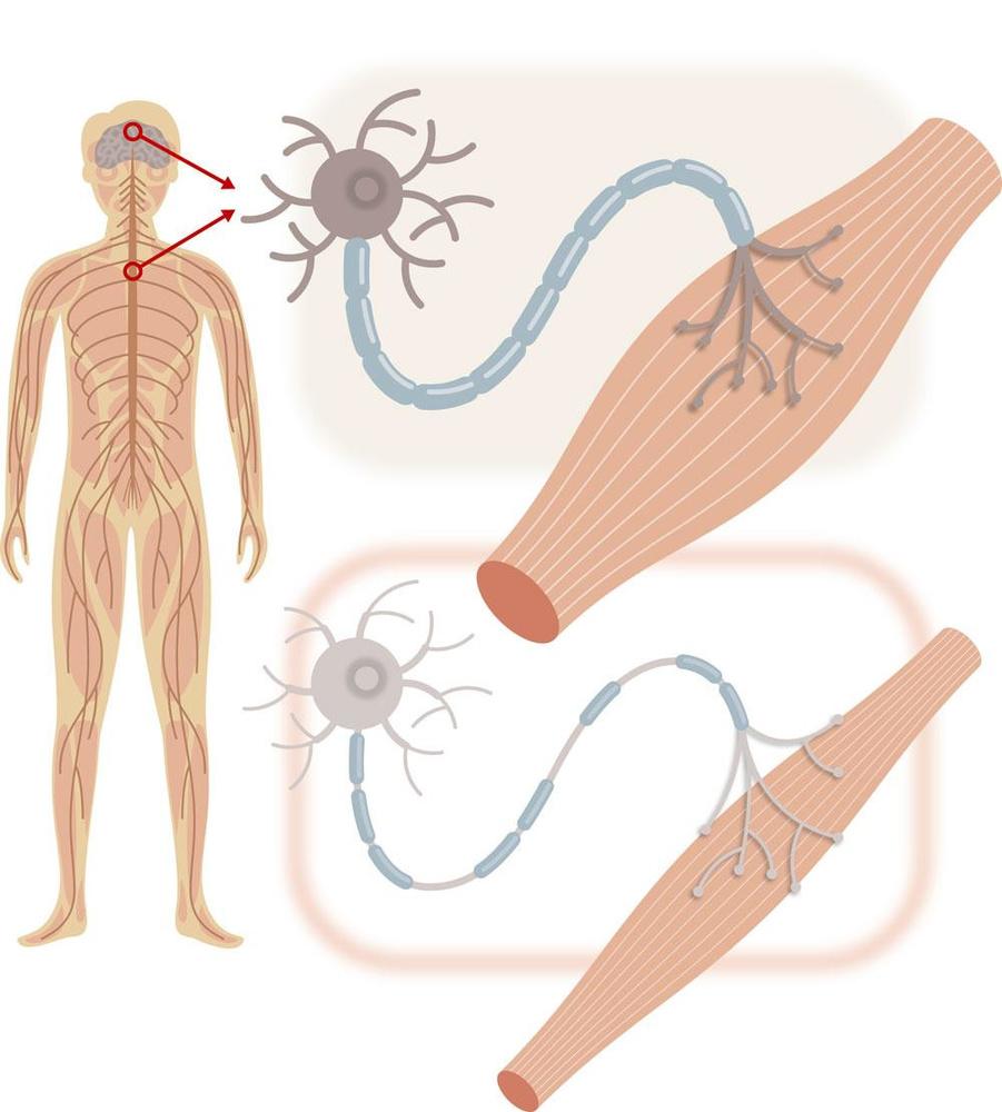 Tout savoir sur la maladie de Charcot