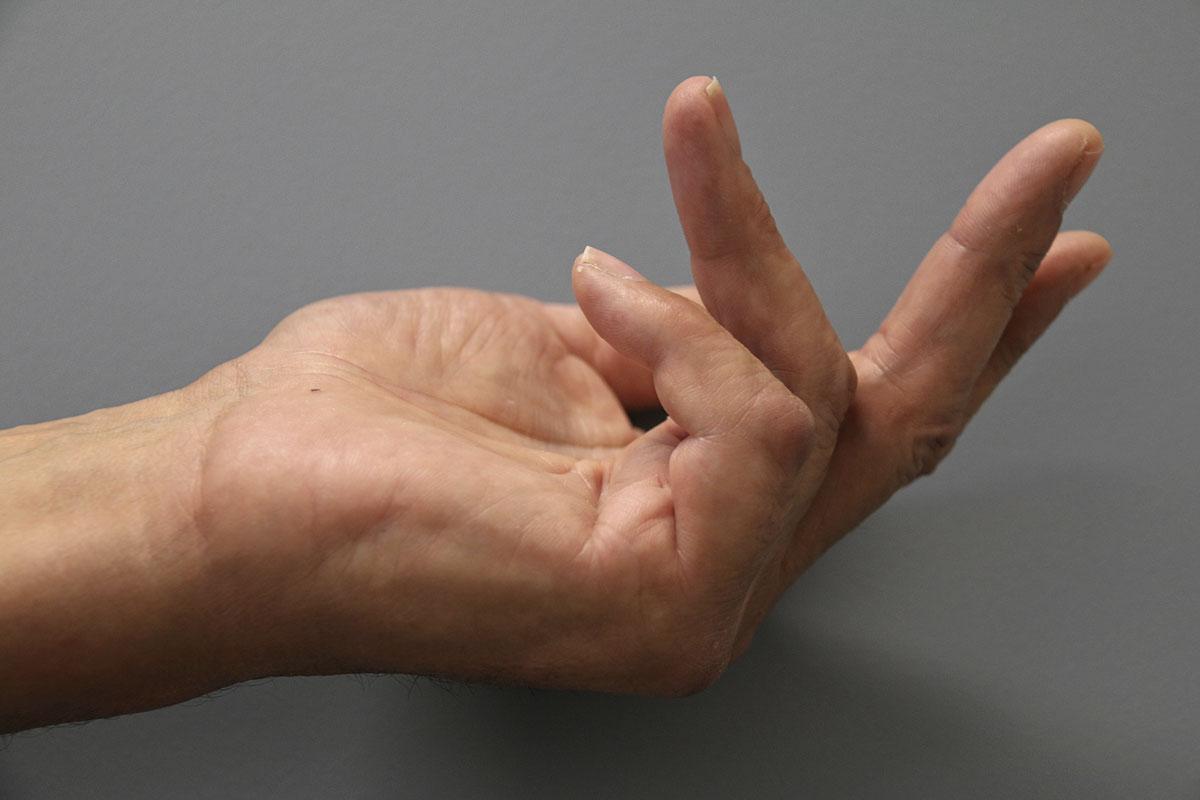 Vooral de pink en ringvinger trekken richting handpalm.