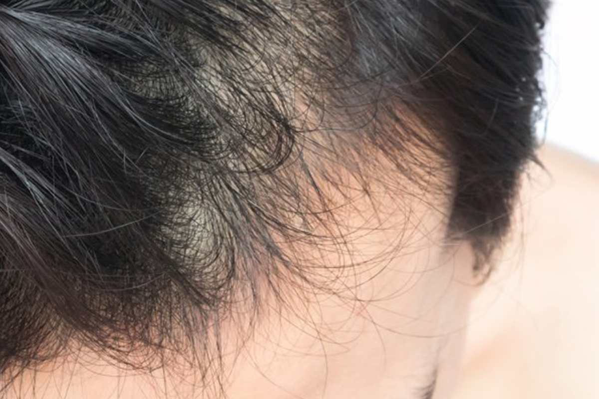 Anti-roos shampoo om uw hoofdhuid weer gezond te krijgen