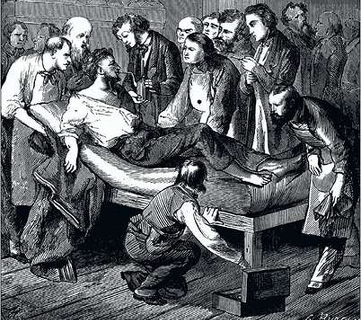 De patiënt op deze illustratie krijgt ether toegediend. De artsen op het slagveld hadden soms opiumtinctuur en laudanum bij, maar nooit voldoende. Vaak was een slok sterkedrank de enige verdoving. © Getty Images