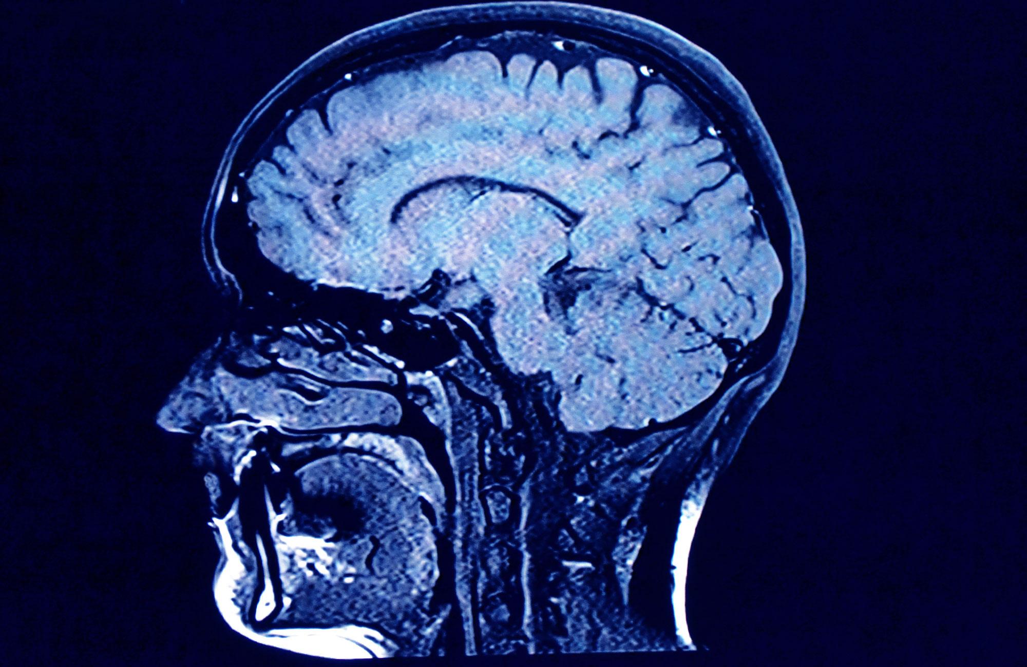 l'atrophie du cerveau: les causes et symptoms