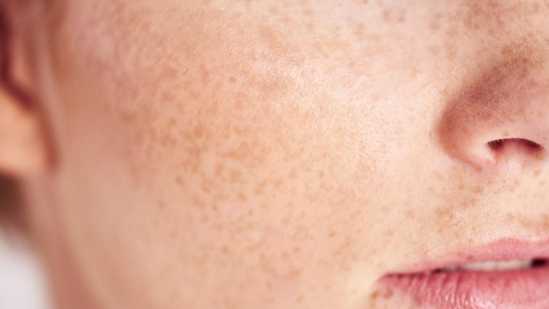 Comment différencier une peau sèche d'une peau déshydratée? Comment différencier une peau sèche d'une peau déshydratée?