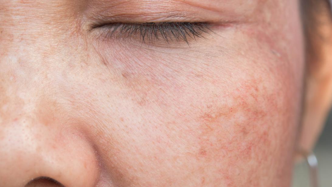 Deze triggers kunnen rosacea in de hand werken volgens experts Deze triggers kunnen rosacea in de hand werken volgens experts