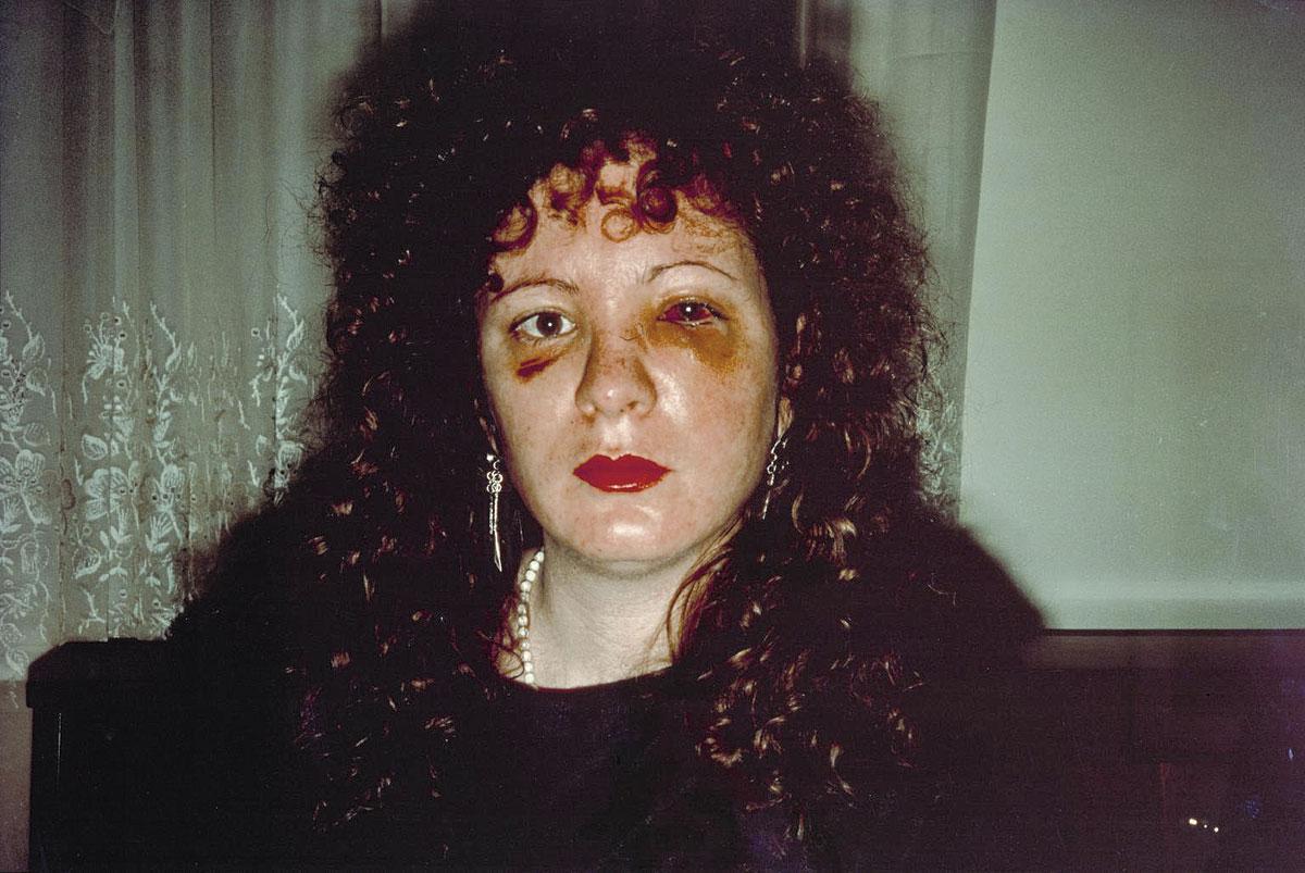Nan One Month after Being Battered, Nan Goldin, 1984