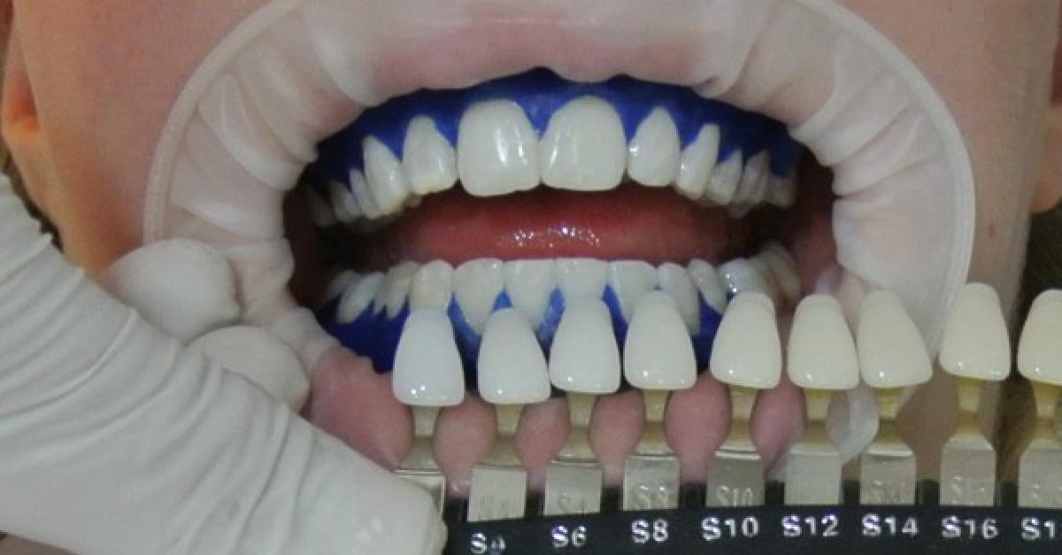 Relatie helper draai Review: je tanden laten bleken
