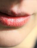 droge lippen