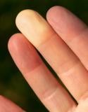 Raynaud