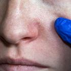 Hand met handschoen toont couperose op het gezicht van een jonge vrouw.