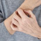 démangeaisons chroniques