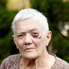 Oudere dame met kort wit haar en blauw oog aan linkerkant kijkt in de camera.