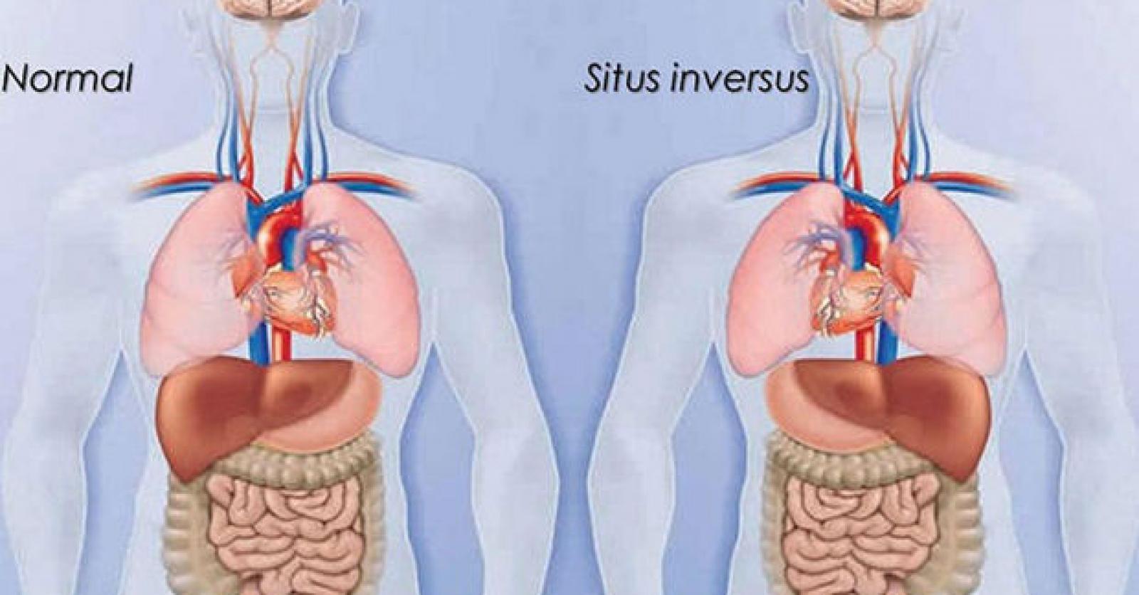 Wat als je lever aan de linkerkant van je lichaam zit?