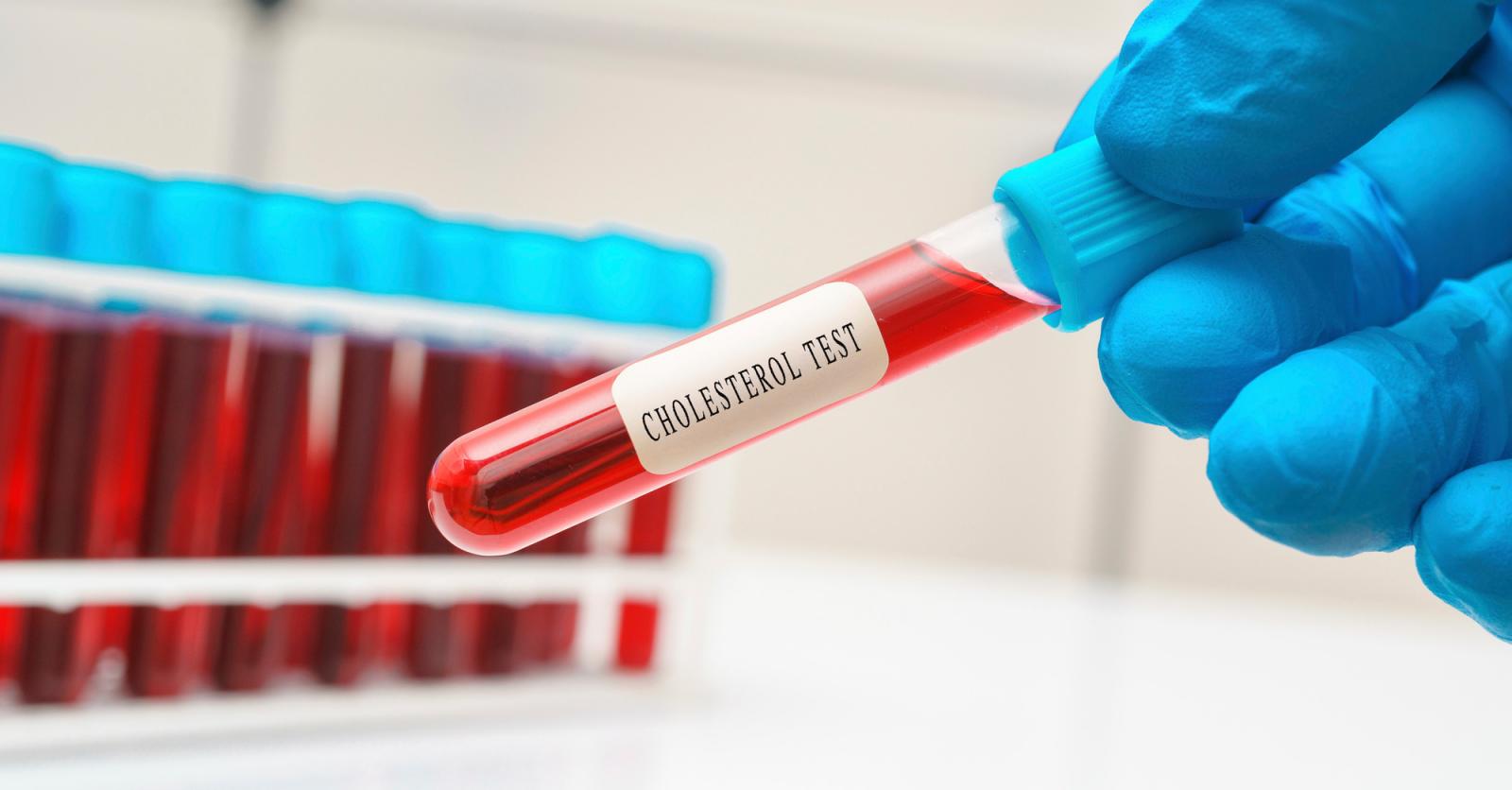 Meten is weten wanneer moet je je cholesterol laten bepalen? Plus