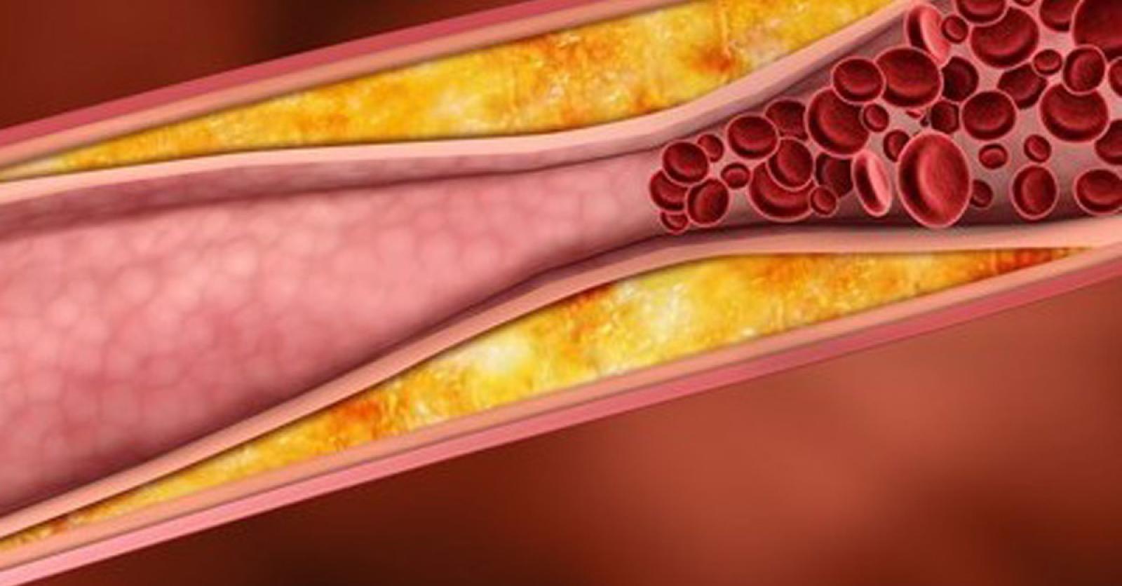 Kunnen omega3 cholesterol verlagen? Plus Magazine