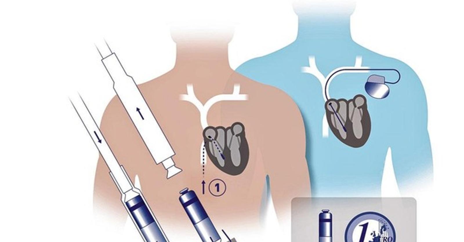 Kleinste pacemaker ooit voor wie bijsturing van één hartkamer nodig ...